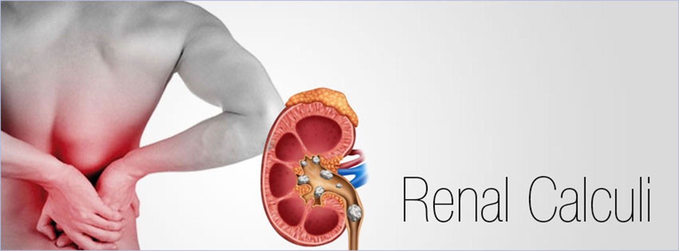 renal-calculi-or-renal-stone-symptoms-cause-and-treatment-with-homeopathy